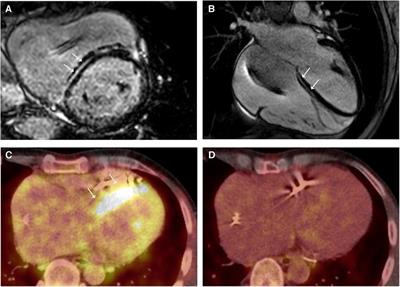 Case Report: Four cases of cardiac sarcoidosis in patients with inherited cardiomyopathy—a phenotypic overlap, co-existence of two rare cardiomyopathies or a second-hit disease